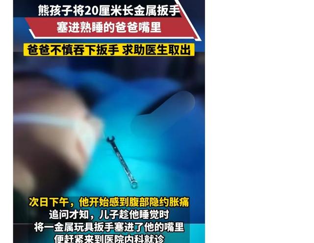 张嘴睡觉误吞20cm扳手尽不知道.