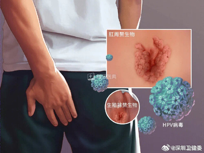 男性感染HPV后怎么看出来？大部分可能都是无症状