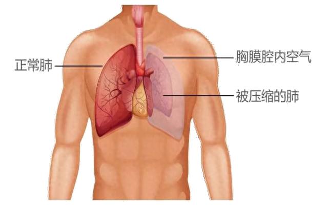 揭秘气胸：这种胸腔内的“不速之客”究竟是何方神圣